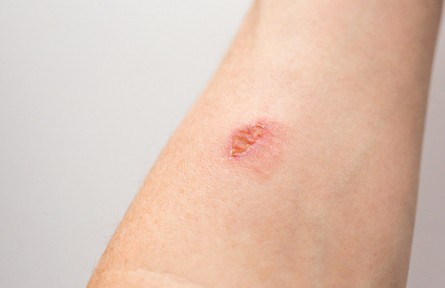 辟謠|燙傷后，可用白糖急救？